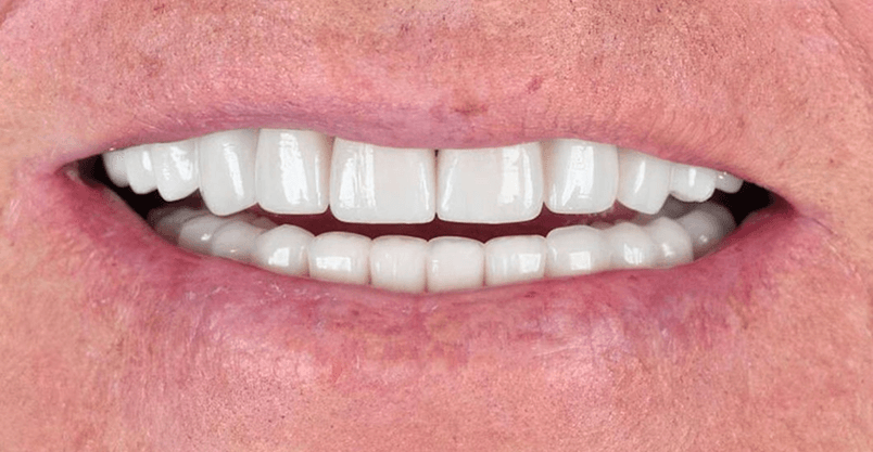 Happy patient pointing to smile