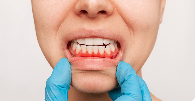 Happy patient pointing to smile