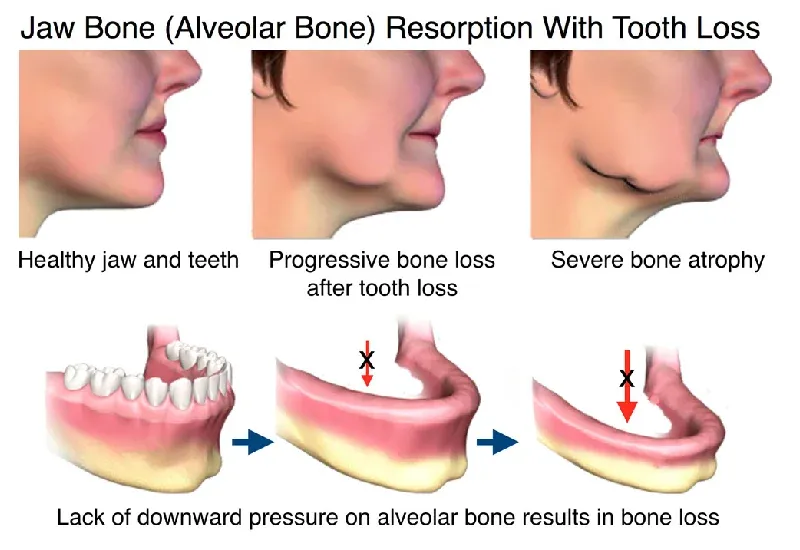 Jawbone Loss Causes, Risk, and How Bone Grafting Restores Strength